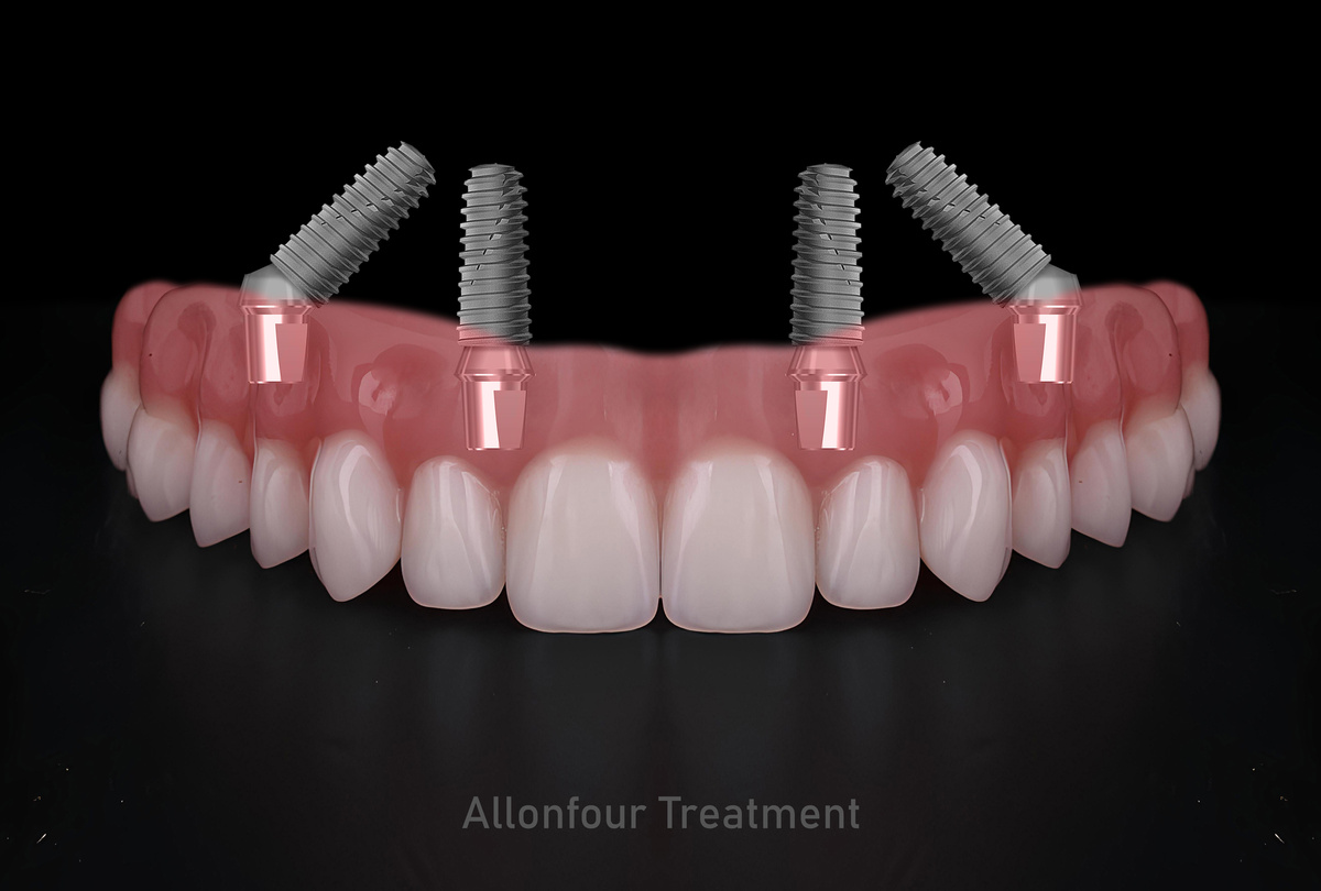 In dental implant surgery, the All-on-Four, All-on-4, and All-on-X treatments involve placing full-arch dental prostheses on cylindrical titanium implants applied to the upper jaw. Dental before after