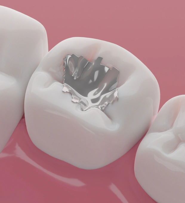 natural looking dental fillings