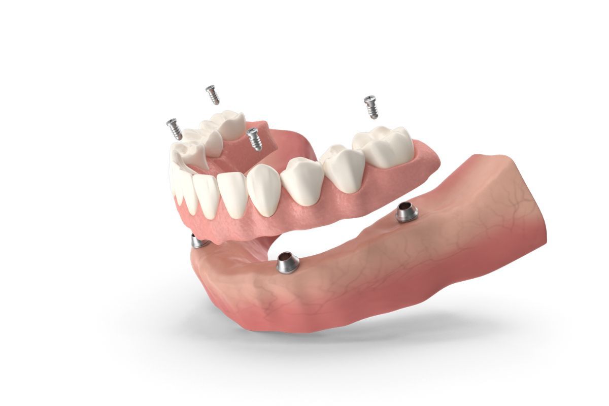 all-on-x dental implants