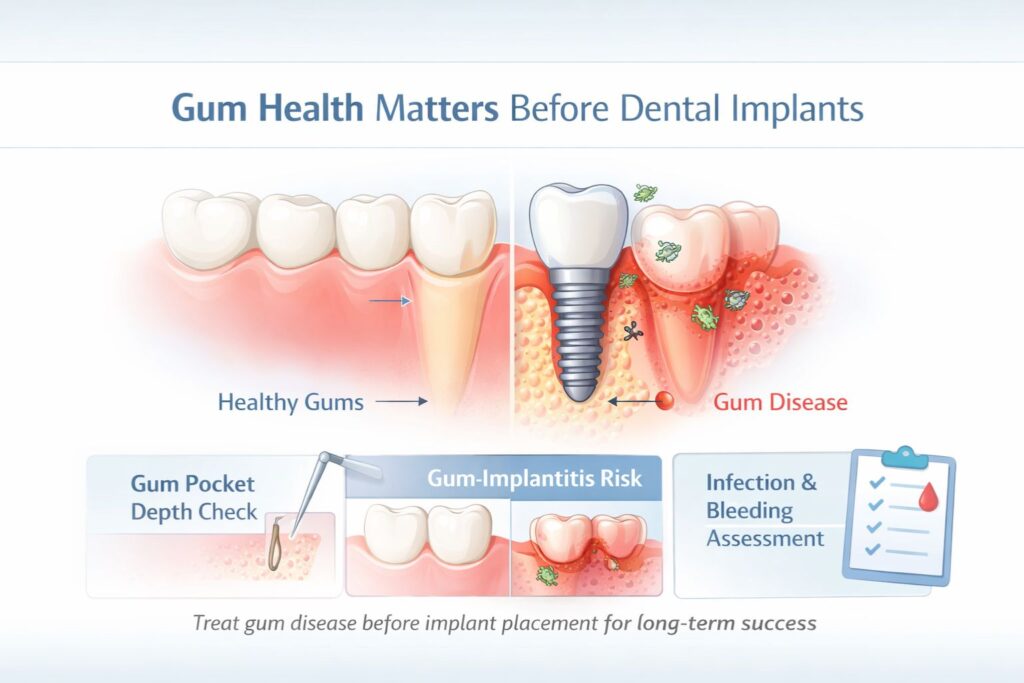 gum health matters before dental implants