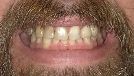 before implants treatment