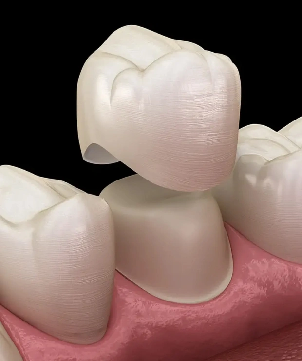 cerec same day crowns in pittsburgh, pa