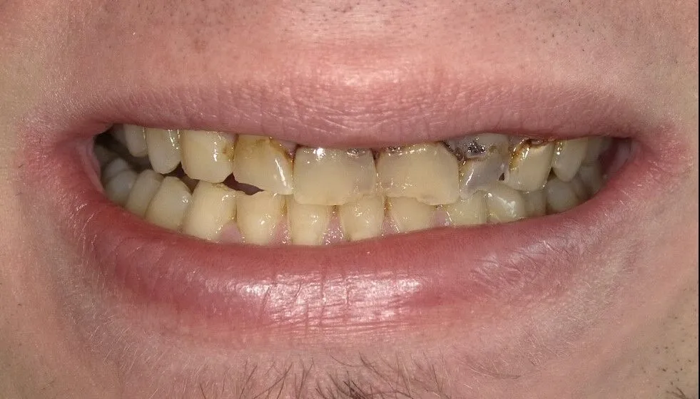 condition before the dental crowns and bridges treatment