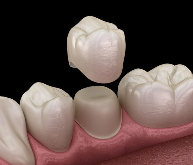 dental crown and bridge solutions