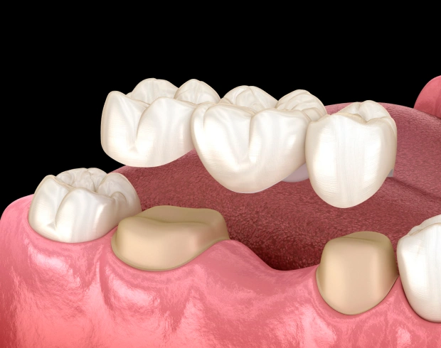 dental crowns and bridges in pittsburgh, pa