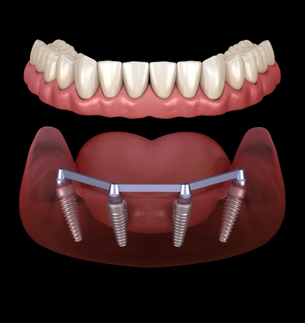 dental implant evaluation and placement process