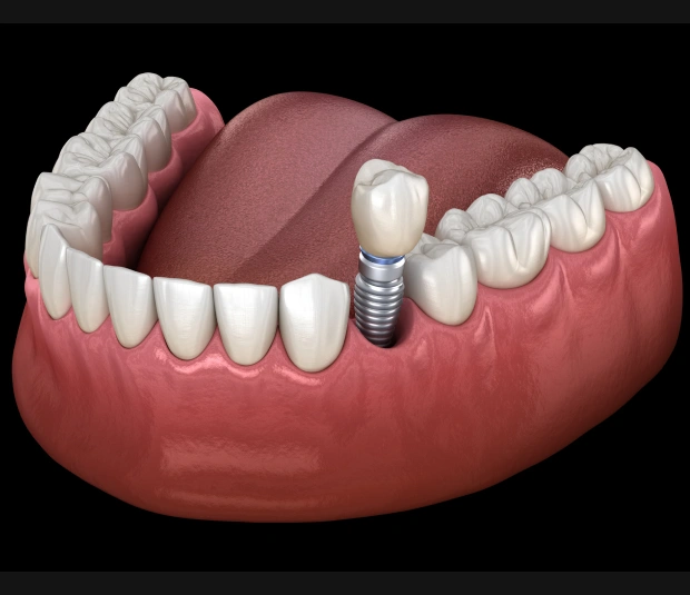 dental implants in mcmurray, pa