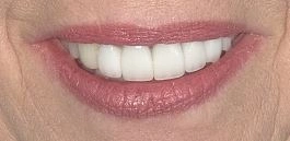 enhanced smile after using veneers