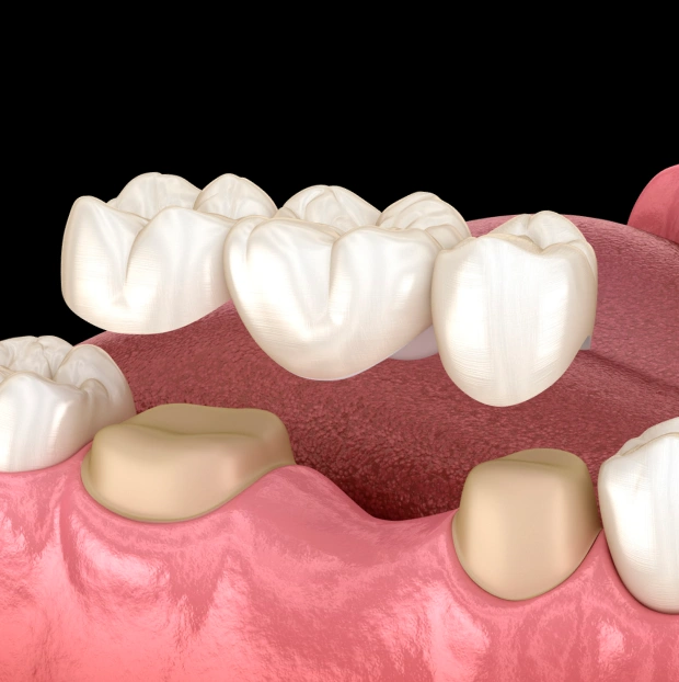 same day crowns and bridges experience in mcmurray, pa