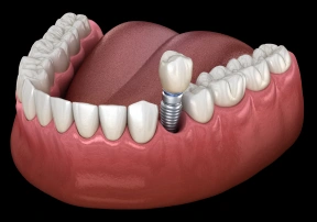 single tooth implants in pittsburgh, pa