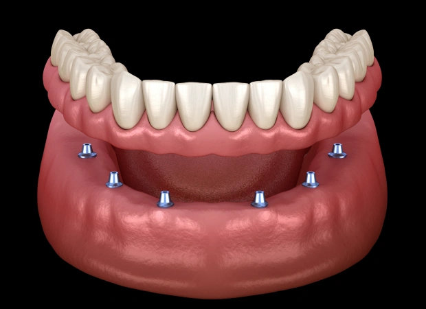 snap-in-implant dentures in mcmurray, pa