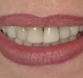 Before treatment